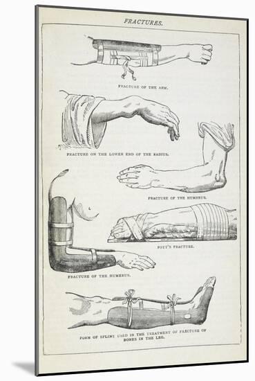 Fractures and Methods Of Bandaging.-Isabella Beeton-Mounted Giclee Print