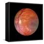 Fundus Camera Image of a Normal Retina, Caucasian-Rory McClenaghan-Framed Stretched Canvas