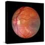 Fundus Camera Image of a Normal Retina, Caucasian-Rory McClenaghan-Stretched Canvas
