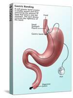 Gastric Banding-Gwen Shockey-Stretched Canvas