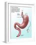 Gastric Banding-Gwen Shockey-Framed Giclee Print