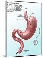 Gastric Banding-Gwen Shockey-Mounted Giclee Print