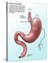 Gastric Banding-Gwen Shockey-Stretched Canvas