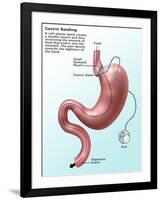 Gastric Banding-Gwen Shockey-Framed Giclee Print