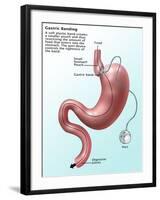 Gastric Banding-Gwen Shockey-Framed Giclee Print