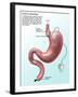 Gastric Banding-Gwen Shockey-Framed Giclee Print