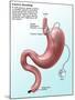 Gastric Banding-Gwen Shockey-Mounted Giclee Print