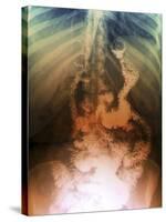 Gastric Bypass Surgery, X-ray-ZEPHYR-Stretched Canvas