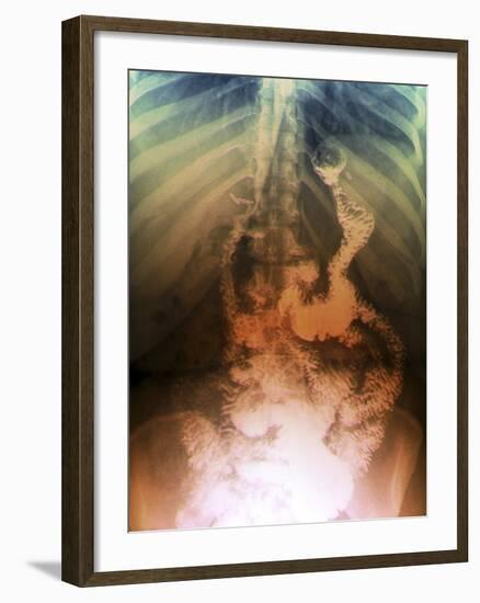 Gastric Bypass Surgery, X-ray-ZEPHYR-Framed Photographic Print