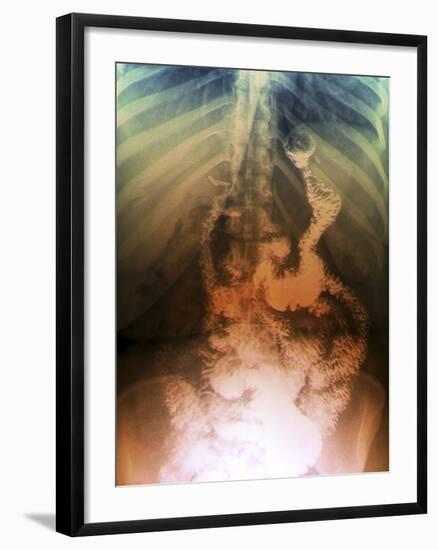 Gastric Bypass Surgery, X-ray-ZEPHYR-Framed Photographic Print