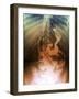 Gastric Bypass Surgery, X-ray-ZEPHYR-Framed Photographic Print