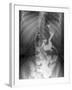 Gastric Bypass Surgery, X-ray-ZEPHYR-Framed Photographic Print