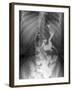 Gastric Bypass Surgery, X-ray-ZEPHYR-Framed Photographic Print