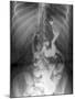 Gastric Bypass Surgery, X-ray-ZEPHYR-Mounted Photographic Print