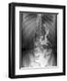 Gastric Bypass Surgery, X-ray-ZEPHYR-Framed Photographic Print