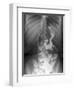 Gastric Bypass Surgery, X-ray-ZEPHYR-Framed Photographic Print