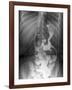 Gastric Bypass Surgery, X-ray-ZEPHYR-Framed Photographic Print