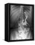 Gastric Bypass Surgery, X-ray-ZEPHYR-Framed Stretched Canvas