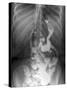 Gastric Bypass Surgery, X-ray-ZEPHYR-Stretched Canvas