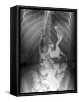 Gastric Bypass Surgery, X-ray-ZEPHYR-Framed Stretched Canvas