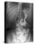 Gastric Bypass Surgery, X-ray-ZEPHYR-Stretched Canvas