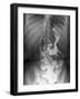 Gastric Bypass Surgery, X-ray-ZEPHYR-Framed Photographic Print