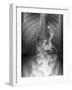 Gastric Bypass Surgery, X-ray-ZEPHYR-Framed Photographic Print