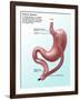 Gastric Bypass Surgery-Gwen Shockey-Framed Giclee Print