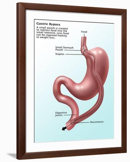 Gastric Bypass Surgery-Gwen Shockey-Framed Giclee Print