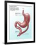 Gastric Bypass Surgery-Gwen Shockey-Framed Giclee Print