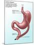 Gastric Bypass Surgery-Gwen Shockey-Mounted Giclee Print