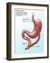 Gastric Bypass Surgery-Gwen Shockey-Framed Giclee Print