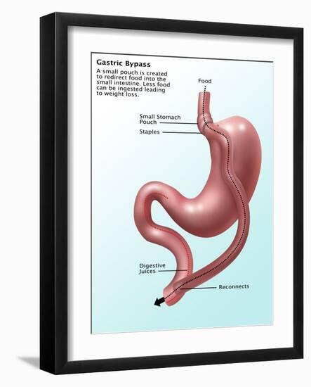 Gastric Bypass Surgery-Gwen Shockey-Framed Giclee Print