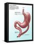 Gastric Bypass Surgery-Gwen Shockey-Framed Stretched Canvas