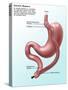 Gastric Bypass Surgery-Gwen Shockey-Stretched Canvas