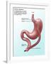 Gastric Bypass Surgery-Gwen Shockey-Framed Premium Giclee Print