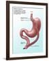 Gastric Bypass Surgery-Gwen Shockey-Framed Premium Giclee Print