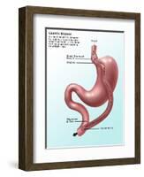 Gastric Bypass Surgery-Gwen Shockey-Framed Giclee Print