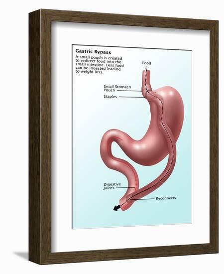 Gastric Bypass Surgery-Gwen Shockey-Framed Giclee Print