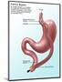 Gastric Bypass Surgery-Gwen Shockey-Mounted Giclee Print