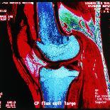 Coloured MRI Scan of Human Knee Joint, Side View-Geoff Tompkinson-Framed Premium Photographic Print
