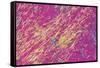Gout Crystals-Dr. E. Walker-Framed Stretched Canvas