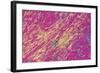 Gout Crystals-Dr. E. Walker-Framed Premium Photographic Print