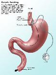 Gastric Banding-Gwen Shockey-Giclee Print