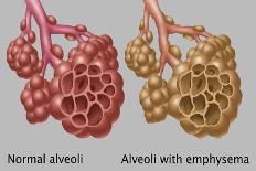 Normal vs. Emphysematous Alveoli-Gwen Shockey-Giclee Print