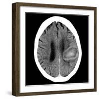 Haematoma, CT Scan-Du Cane Medical-Framed Photographic Print