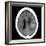 Haematoma, CT Scan-Du Cane Medical-Framed Photographic Print