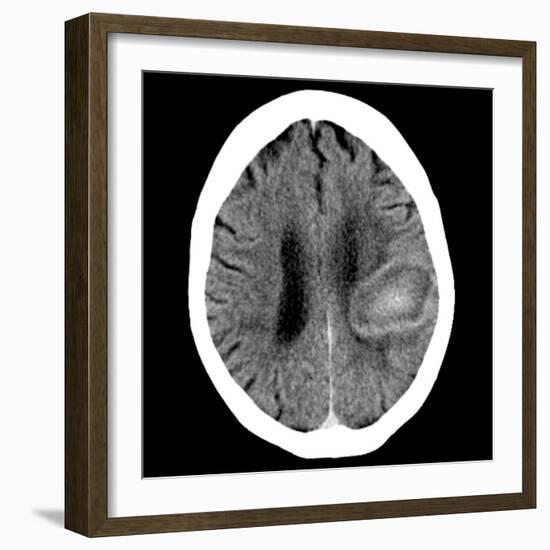 Haematoma, CT Scan-Du Cane Medical-Framed Photographic Print