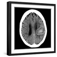 Haematoma, CT Scan-Du Cane Medical-Framed Photographic Print