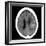 Haematoma, CT Scan-Du Cane Medical-Framed Photographic Print